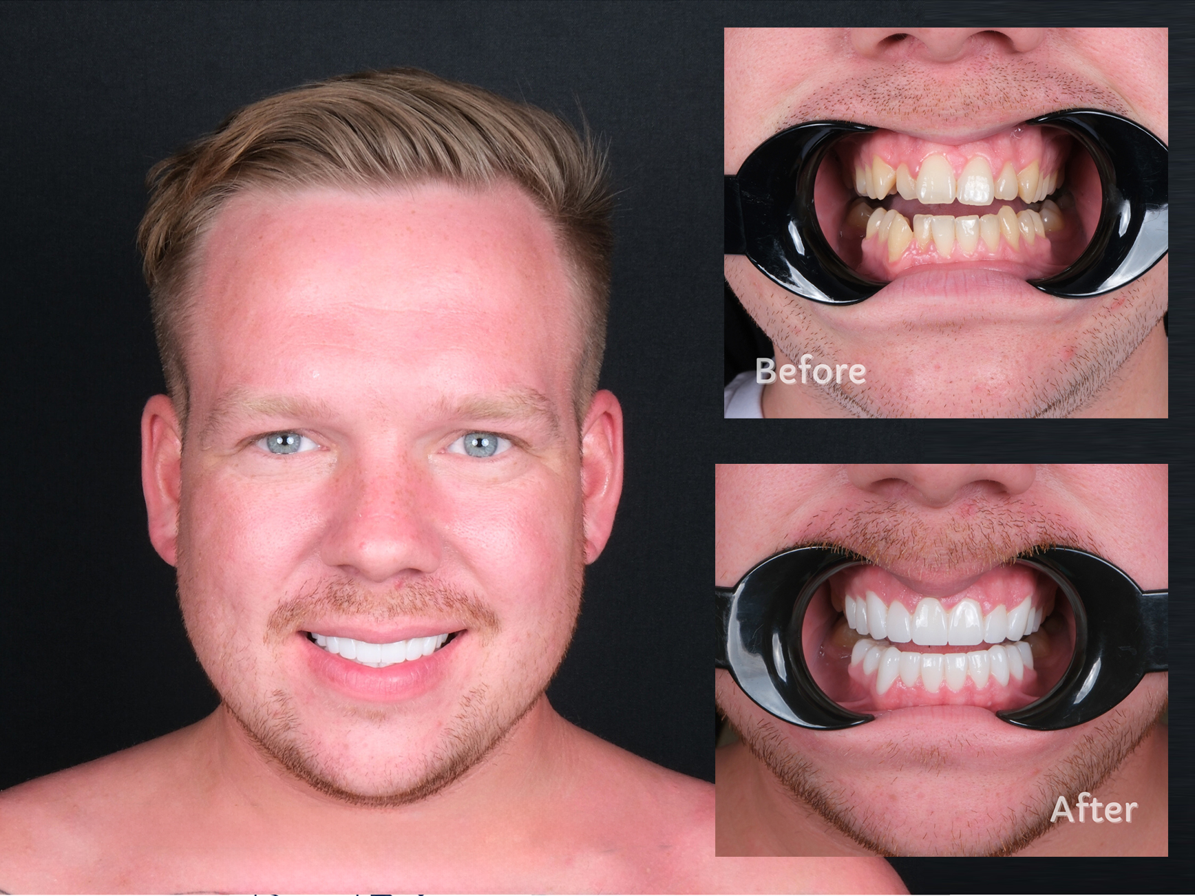 zirconium crowns 1