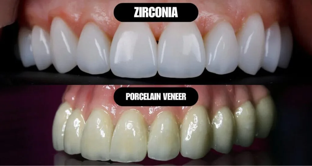 Zirconium Crowns vs Porcelain: Differences, Lifespan & Costs 2 zirconium crowns vs porcelain